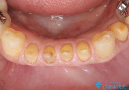前歯がかけた、ぐらぐらする 60代女性の治療中