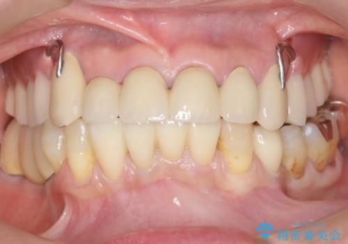 前歯がかけた、ぐらぐらする 60代女性の治療後
