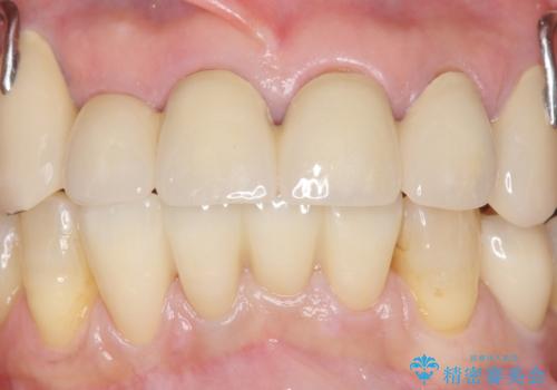 前歯がかけた、ぐらぐらする 60代女性の治療後