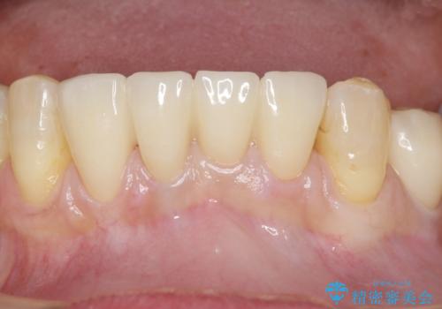 前歯がかけた、ぐらぐらする 60代女性の治療後