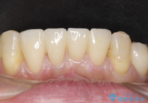 前歯がかけた、ぐらぐらする 60代女性の症例 治療後