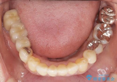 前歯がかけた、ぐらぐらする 60代女性の治療後