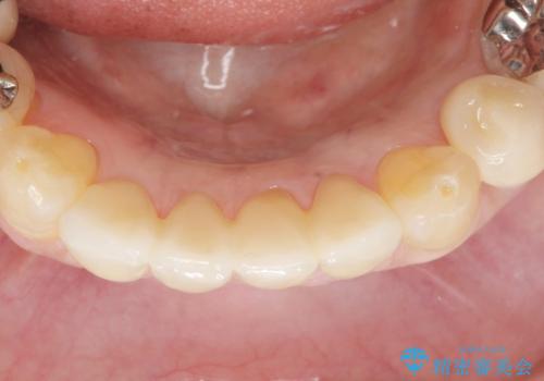 前歯がかけた、ぐらぐらする 60代女性の治療後