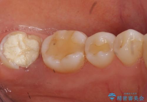 歯が割れた 親知らずの移植 30代女性の治療前