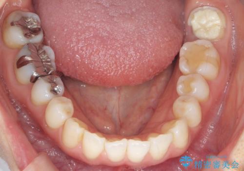 歯が割れた 親知らずの移植 30代女性の治療前