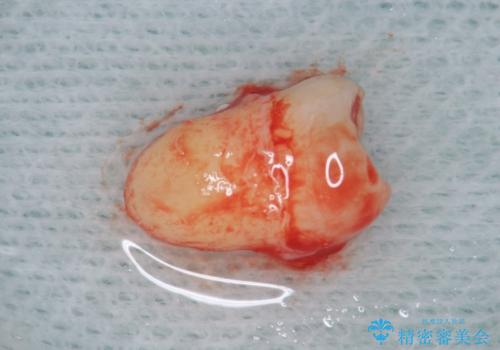 歯が割れた 親知らずの移植 30代女性の治療中