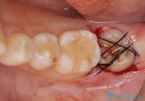 歯が割れた 親知らずの移植 30代女性の治療中