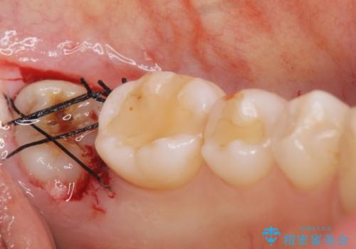 歯が割れた 親知らずの移植 30代女性の治療中