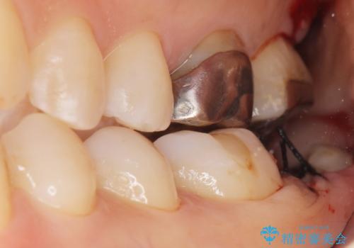 歯が割れた 親知らずの移植 30代女性の治療中