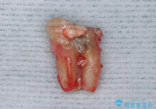 歯が割れた　親知らずの移植　30代女性