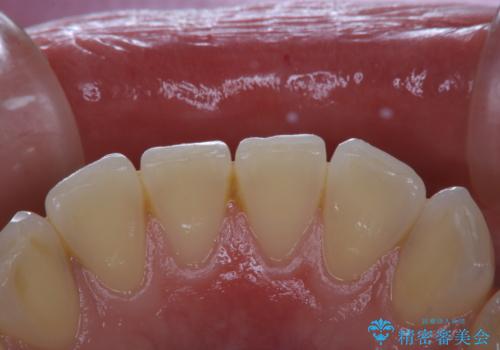 気になる口臭をPMTCで改善の治療前