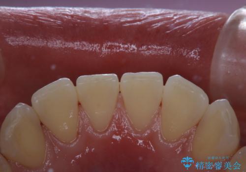 気になる口臭をPMTCで改善の治療後