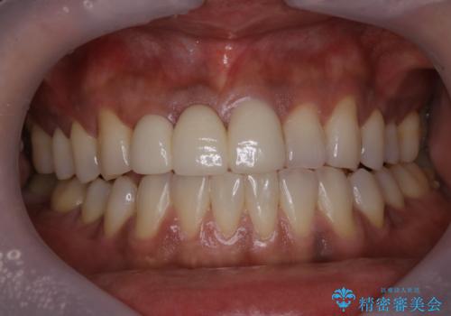 久しぶりのオフィスホワイトニングの症例 治療前