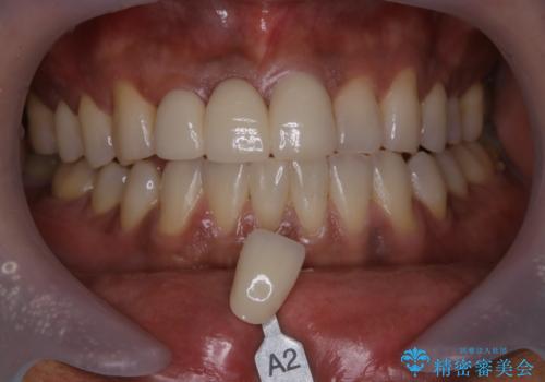 久しぶりのオフィスホワイトニングの治療前