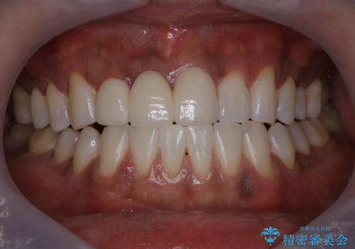 久しぶりのオフィスホワイトニングの症例 治療後