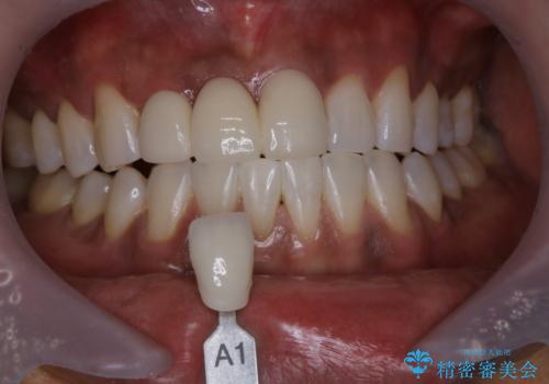 久しぶりのオフィスホワイトニングの治療後