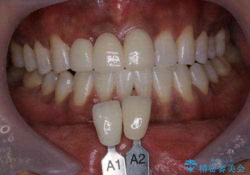 久しぶりのオフィスホワイトニング