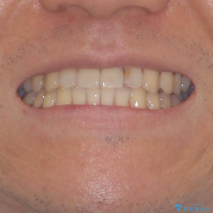 気になる前歯のデコボコをインビザラインで解消の治療後（顔貌）