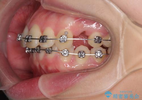 費用を抑えた抜歯矯正　口元の突出感の改善の治療中