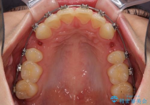 費用を抑えた抜歯矯正　口元の突出感の改善の治療中