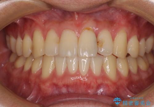 気になる前歯のデコボコをインビザラインで解消の症例 治療後