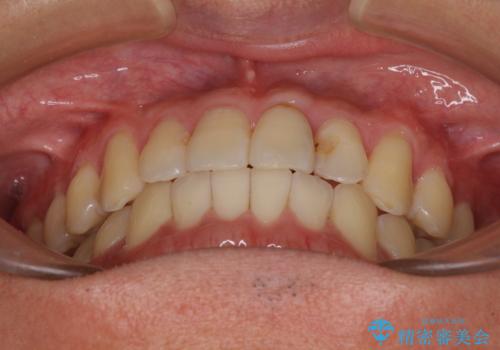 気になる前歯のデコボコをインビザラインで解消の治療後
