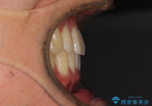 気になる前歯のデコボコをインビザラインで解消の治療後