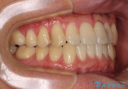 気になる前歯のデコボコをインビザラインで解消の治療後