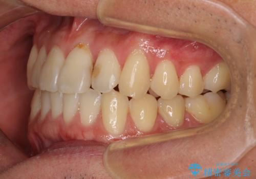 気になる前歯のデコボコをインビザラインで解消の治療後