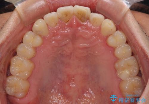 気になる前歯のデコボコをインビザラインで解消の治療後