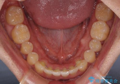 気になる前歯のデコボコをインビザラインで解消の治療後