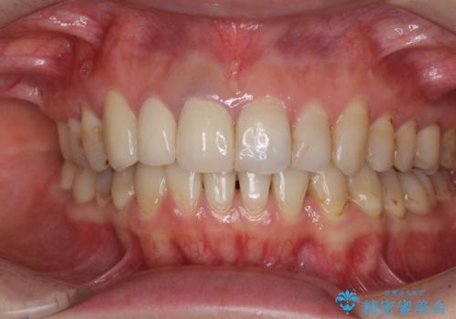 歯並びと目立つ金属を治したい　総合歯科治療の症例 治療後