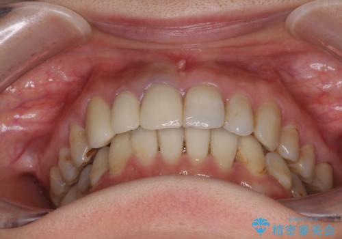 歯並びと目立つ金属を治したい　総合歯科治療の治療後