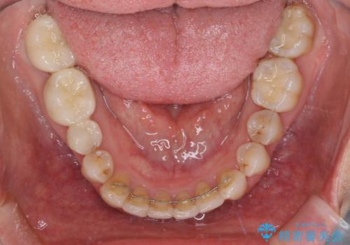 歯並びと目立つ金属を治したい　総合歯科治療の治療後