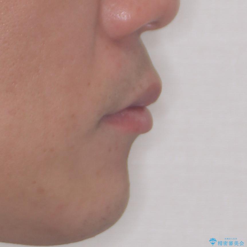 口が閉じにくい インビザラインによる矯正治療の治療後(顔貌)