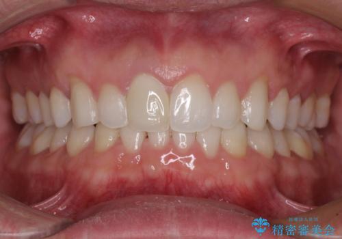 口が閉じにくい インビザラインによる矯正治療の症例 治療後