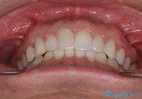 口が閉じにくい インビザラインによる矯正治療の治療後