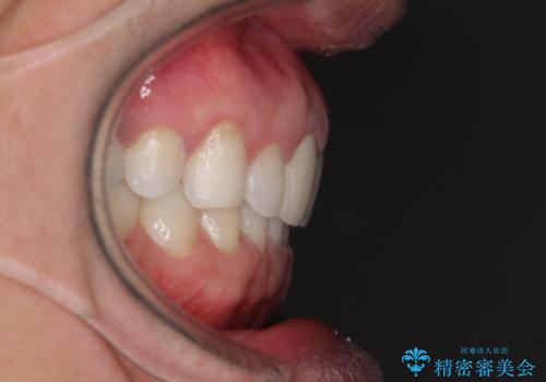 口が閉じにくい インビザラインによる矯正治療の治療後