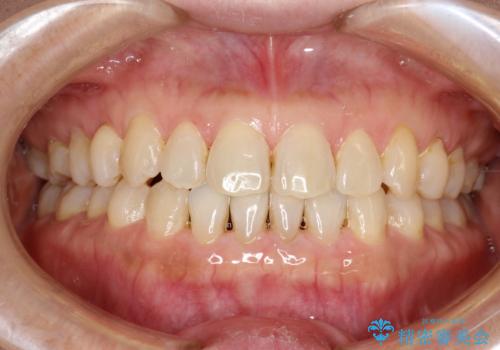 前歯の隙間　インビザラインによる目立たない成人矯正の症例 治療後