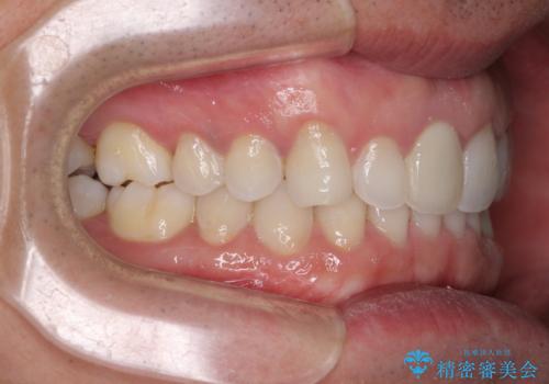 口が閉じにくい インビザラインによる矯正治療の治療後