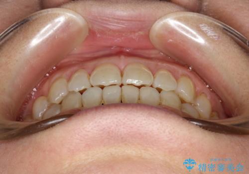 前歯の隙間 インビザラインによる目立たない成人矯正の治療後