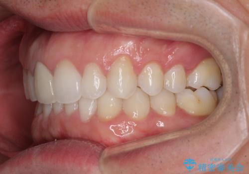 口が閉じにくい インビザラインによる矯正治療の治療後