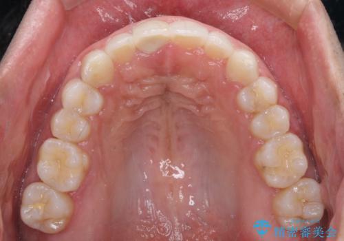 口が閉じにくい インビザラインによる矯正治療の治療後