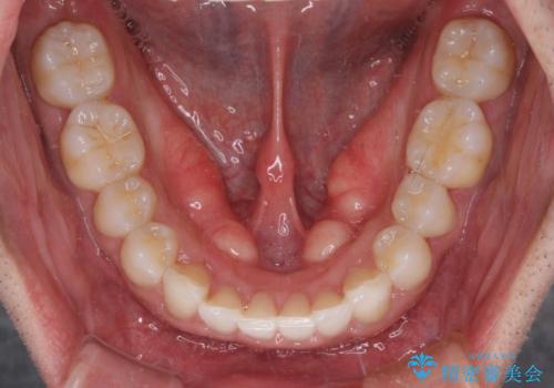 口が閉じにくい インビザラインによる矯正治療の治療後