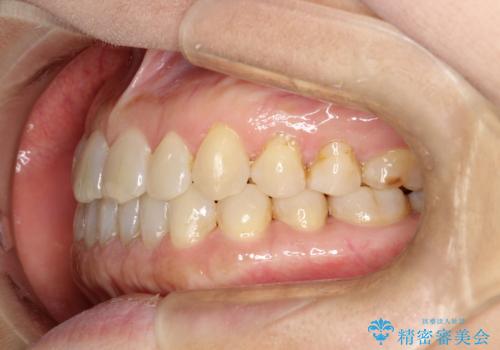 前歯の隙間 インビザラインによる目立たない成人矯正の治療後