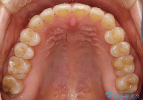 前歯の隙間 インビザラインによる目立たない成人矯正の治療後