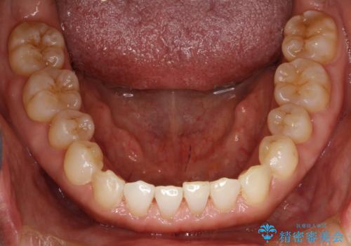 前歯の隙間 インビザラインによる目立たない成人矯正の治療後