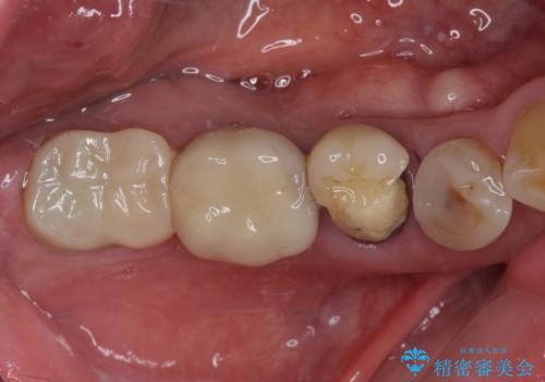 かけて金属の見えてしまったセラミック 強化セラミックでの補綴治療の治療前