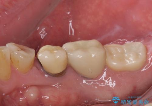 かけて金属の見えてしまったセラミック 強化セラミックでの補綴治療の治療前