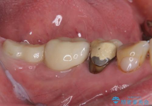 かけて金属の見えてしまったセラミック 強化セラミックでの補綴治療の治療前